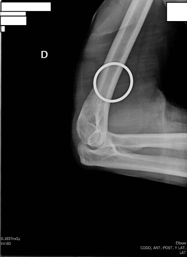 Lateral Elbow Diagram